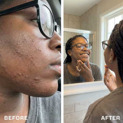 Renovia™ Cyperus Rotundus Skin Serum | Stop Unwanted Hair Growth Naturally