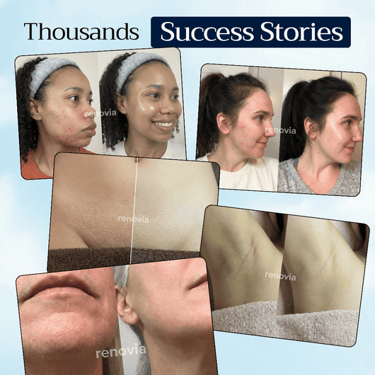 Renovia™ Cyperus Rotundus Skin Serum | Stop Unwanted Hair Growth Naturally